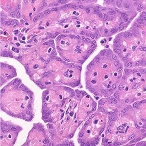 Sarcomatoid cells