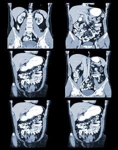 Peritoneal mesothelioma scan