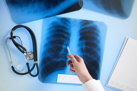 X-ray showing location of intrapleural immunotherapy