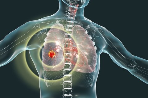 mesothelioma metastasis prevention